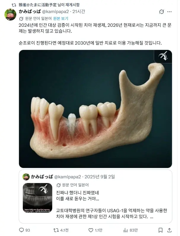 치아 재생 치료 성공.webp